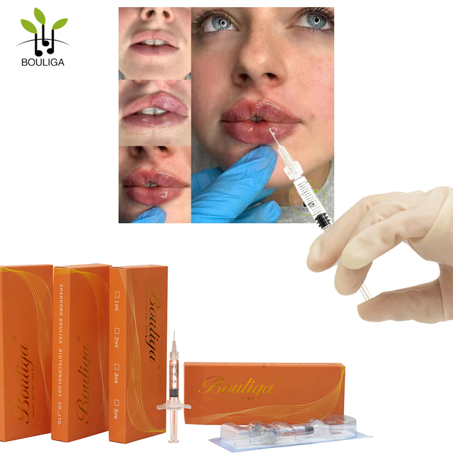 Bouliga Dermal filler 2ml dùng cho môi và nếp nhăn
